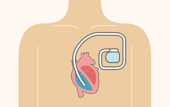 ペースメーカ